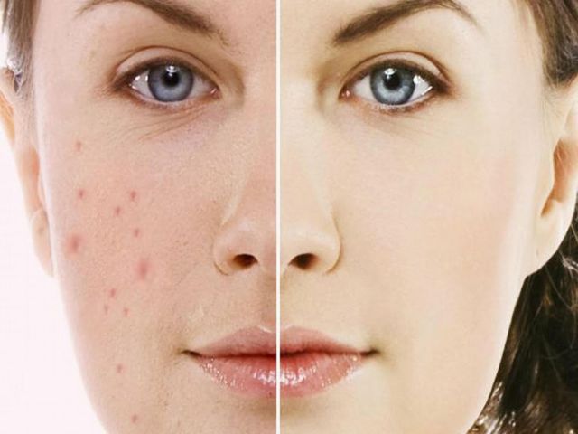Những bài thuốc về củ nghệ điều trị mụn nhọt khá hiệu quả
